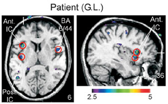 patient gl insular activation