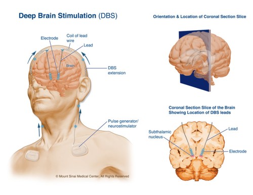 Deep Brain Stimulation