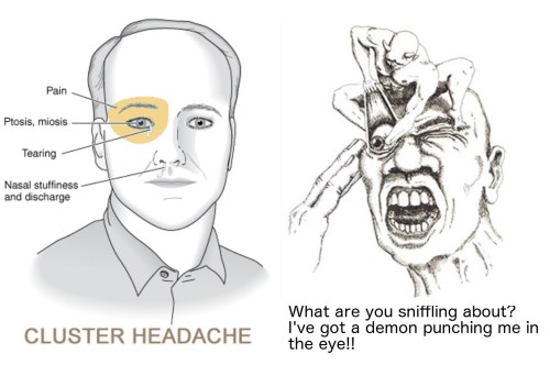 cluster-headache